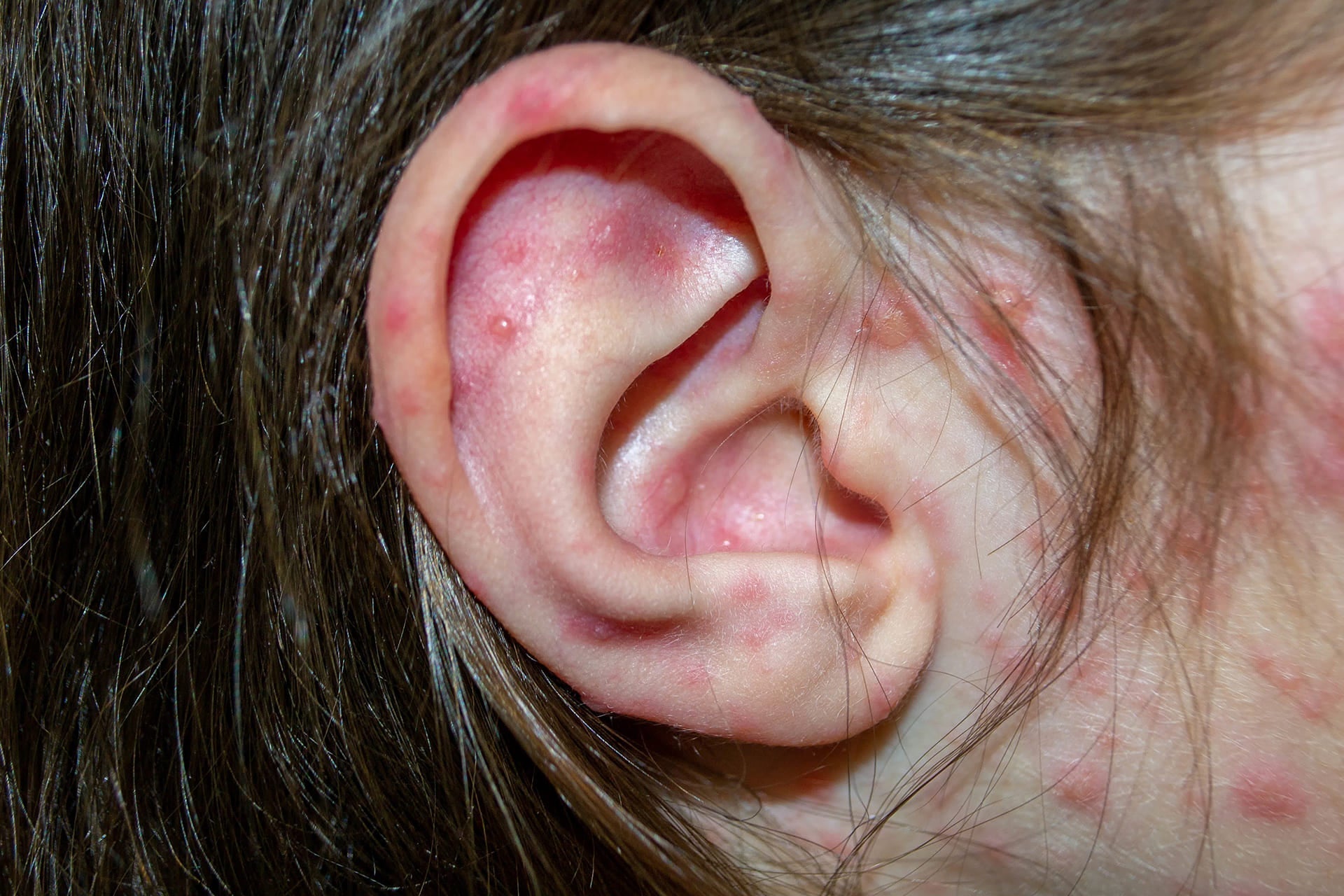 Ear Eczema: Understanding Causes and Effective Treatments